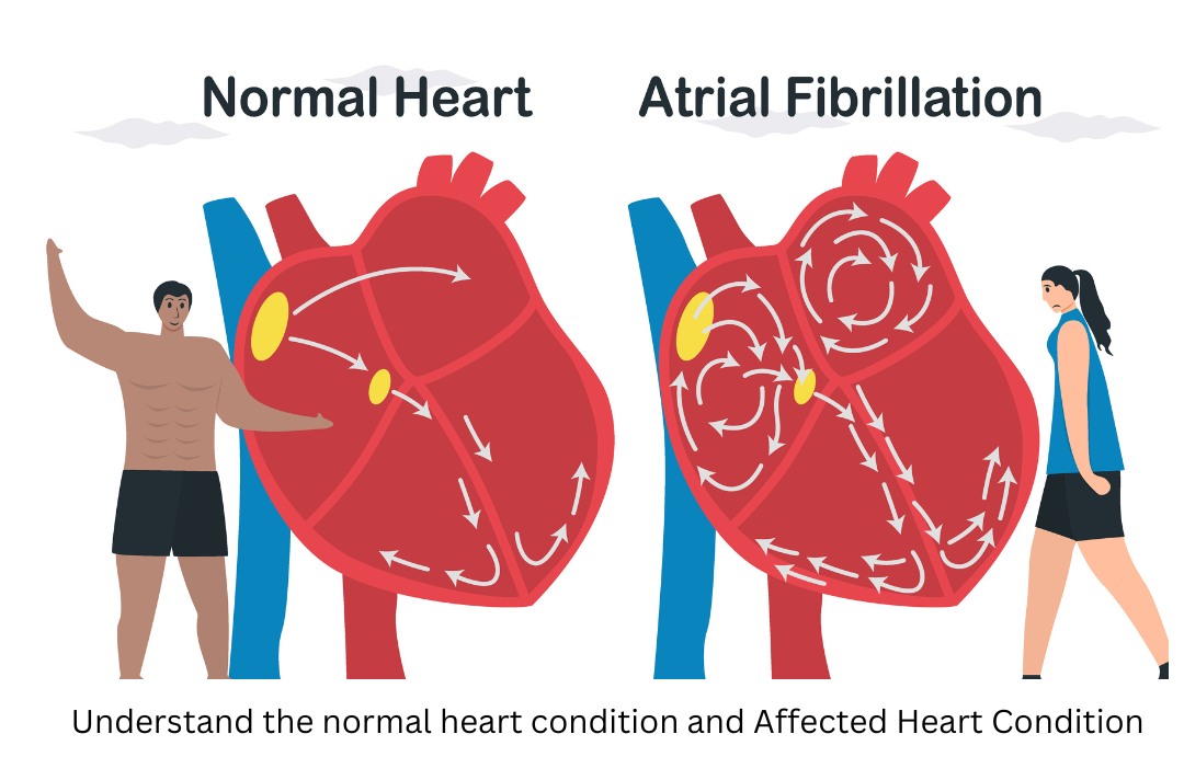 Atrial Fibrillation Cause, Symptoms and Treatment