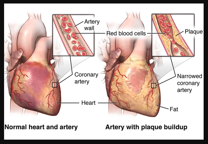 Coronary Artery Disease (CAD), Causes, Symptoms and Treatment