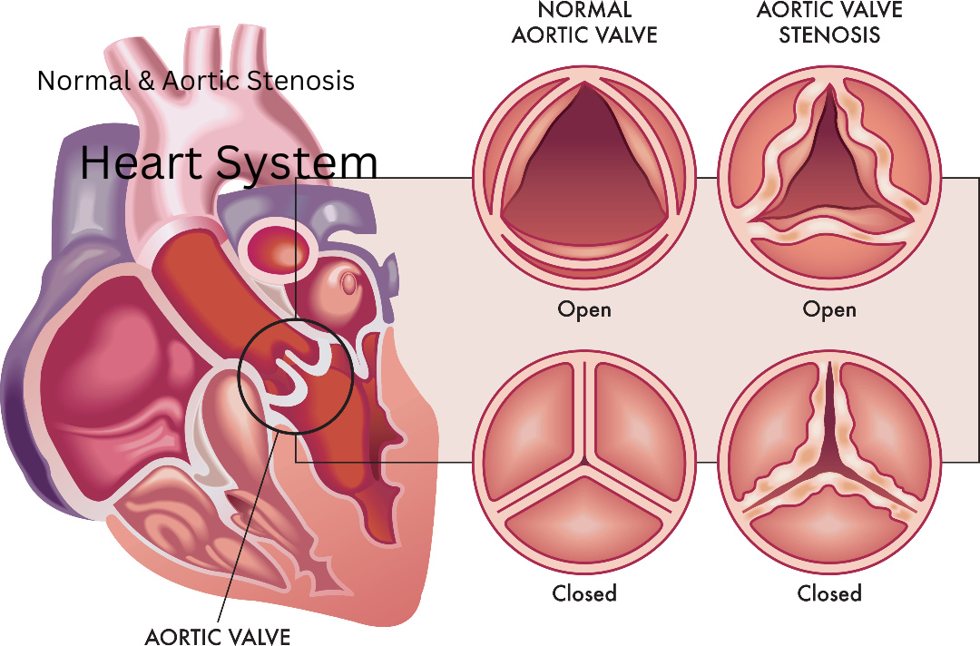 What is Aortic Stenosis