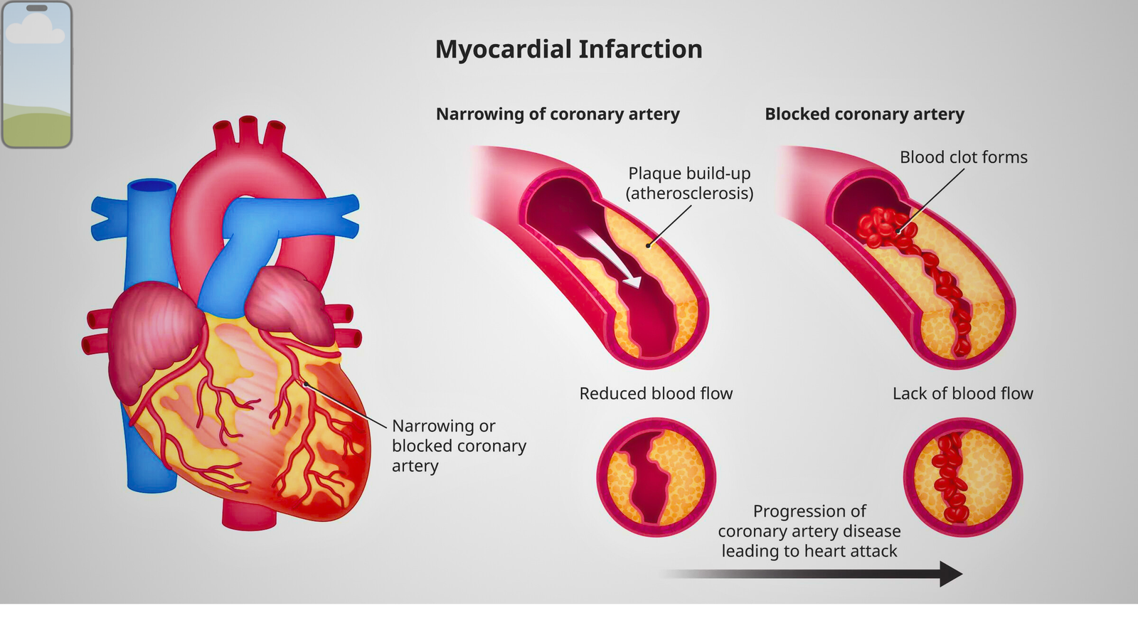 What is Myocardial Infarction? Causes, Symptoms and Treatment